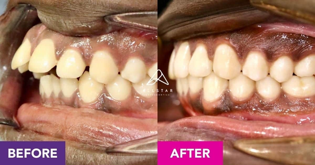 Beji’s Invisalign Journey in New Farm | Allstar Orthodontics