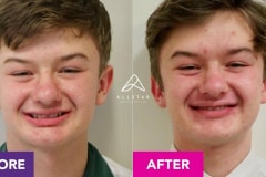 Connor’s Invisalign Journey in Brisbane City | Allstar Orthodontics