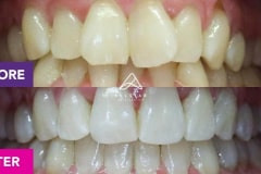 Lisa’s Invisalign Treatment in Brendale | Allstar Orthodontics