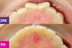 Lisa’s Invisalign Treatment in Brendale | Allstar Orthodontics