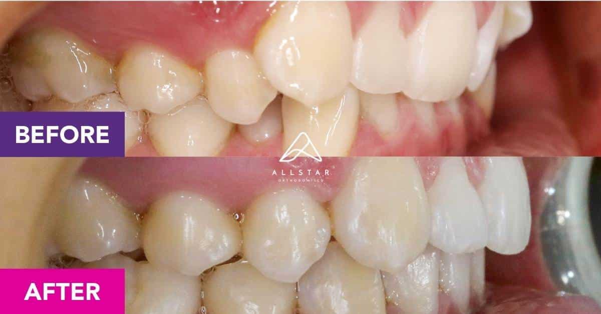 Rachel’s Invisalign Treatment in Hendra | Allstar Orthodontics