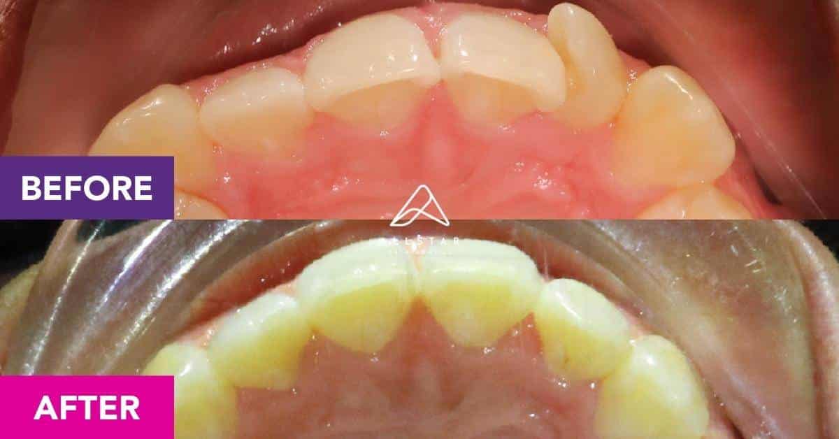 Rachel’s Invisalign Treatment in Hendra | Allstar Orthodontics