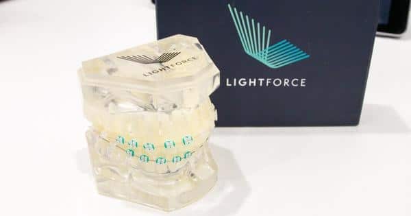 3D LightForce Braces - Brisbane Queensland, Fortitude Valley & Albany Creek - Allstar Orthodontics