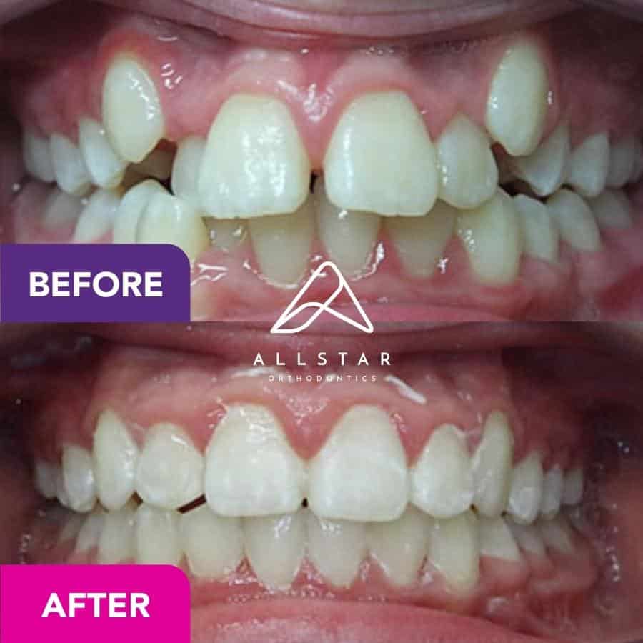 Patient 2 Orthodontic Treatment in Fortitude Valley Allstar Orthodontics