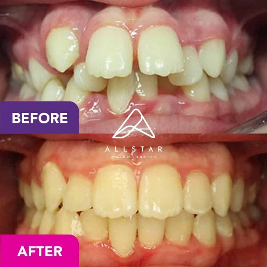 Patient 5 Orthodontic Treatment in Fortitude Valley Allstar Orthodontics