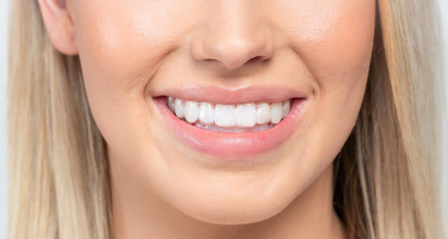 The Benefits of Clear Aligners - Brisbane Queensland, Fortitude Valley & Albany Creek - Allstar Orthodontics