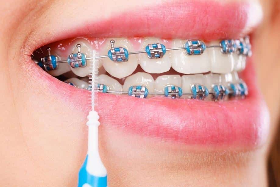 Caring For Your Braces - Brisbane Queensland, Fortitude Valley & Albany Creek - Allstar Orthodontics