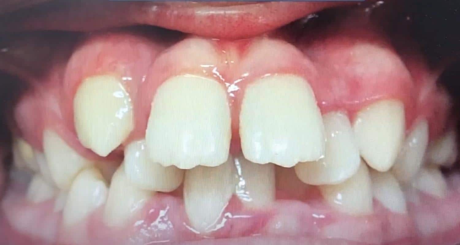 Crowded Teeth - Brisbane Queensland, Fortitude Valley & Albany Creek - Allstar Orthodontics