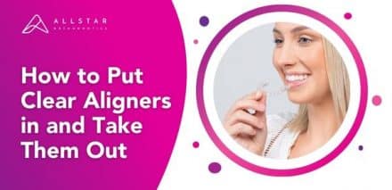 How to Put Clear Aligners in and Take Them Out
