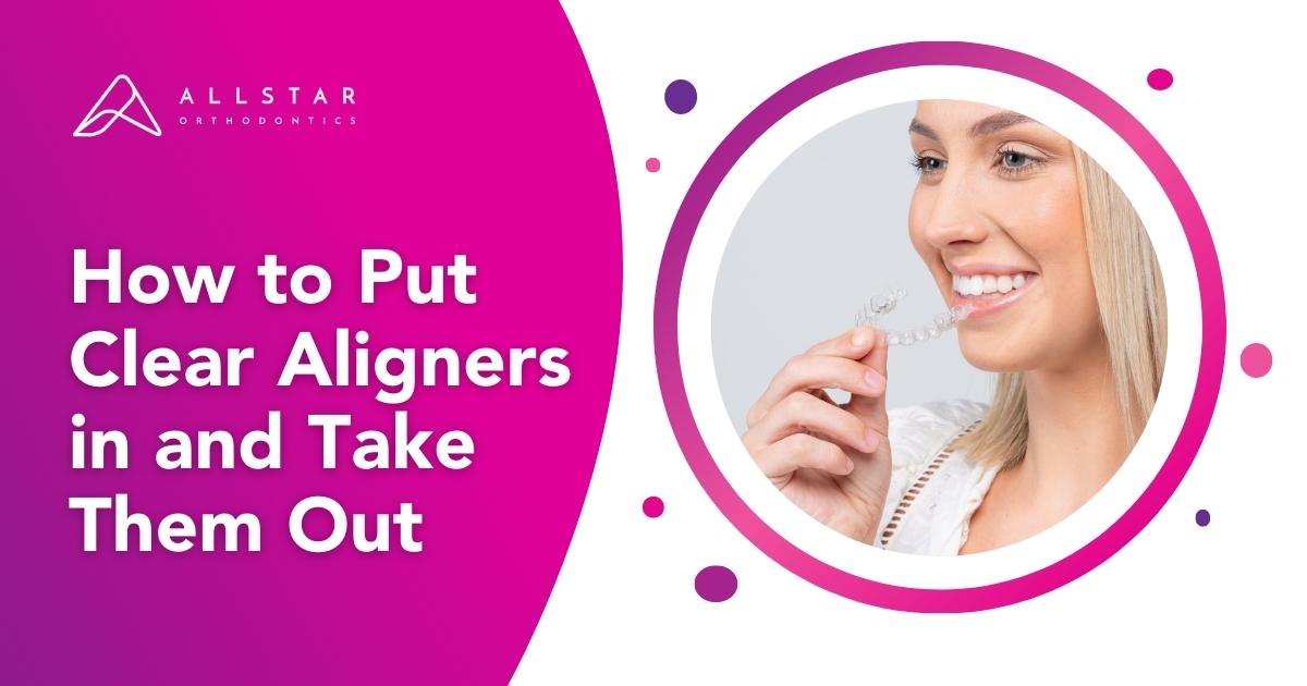 How to Put Clear Aligners in and Take Them Out