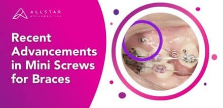 Recent Advancements in Mini Screws for Braces