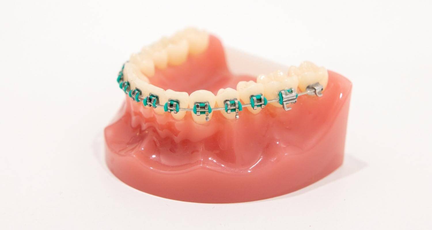 What Are The Different Types Of Braces And The Pros and Cons Of Each One? - Brisbane, Fortitude Valley & Albany Creek - Allstar Orthodontics