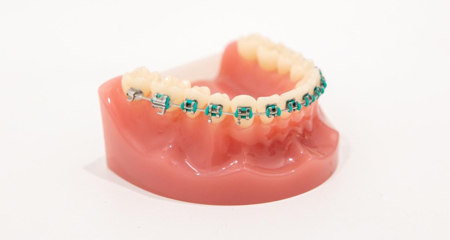 What Are Coloured Braces - Brisbane Queensland, Fortitude Valley & Albany Creek - Allstar Orthodontics