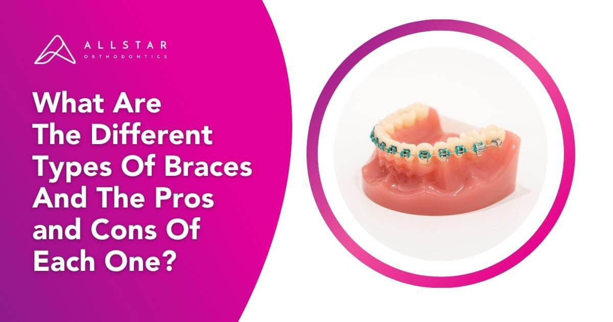 What Are the Different Types of Braces and the Pros and Cons of Each One?